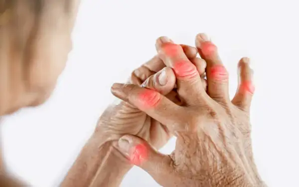 Mains montrant des articulations rouges et enflammées, symptomatiques d'une arthrose du doigt, même chez les jeunes.