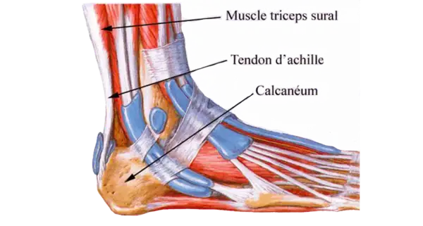 Anatomie du pied montrant le muscle triceps sural, le tendon d'Achille et le calcanéum. Illustration d'une tendinite du tendon d'Achille.