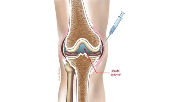 Illustration d'une injection d'acide hyaluronique dans le genou. Avis sur cette procédure pour soulager la douleur.