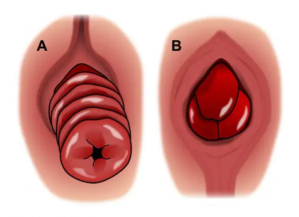 Illustration A montre un prolapsus rectal en plusieurs couches, tandis que B illustre un prolapsus d'organe chez l'homme.