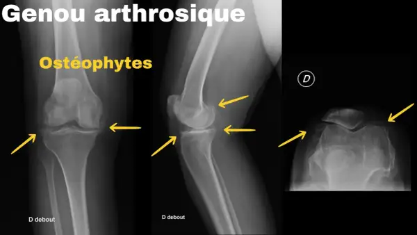 Radiographies du genou montrant un arthrose genou stade 4 avec ostéophytes marqués, rétrécissement de l'espace articulaire et déformations osseuses.
