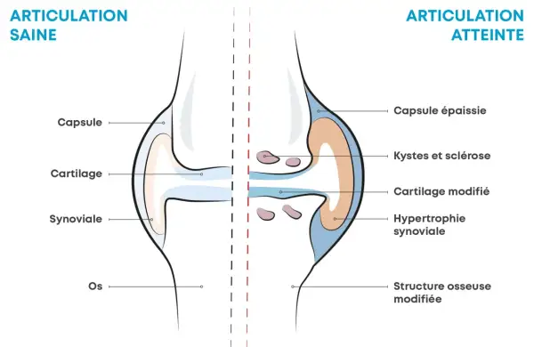 Comparaison d'une articulation saine et d'une articulation atteinte d'arthrose, montrant les symptômes : cartilage modifié, kystes, hypertrophie synoviale.
