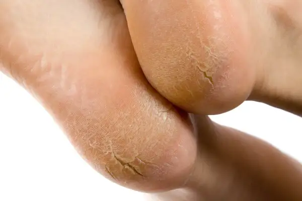 Talons secs et craquelés, un remède miracle corne aux pieds est recherché pour retrouver une peau douce.