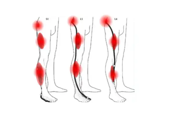 Schéma montrant les zones de douleur du nerf sciatique, incluant le mollet, avec des points rouges indiquant l'inflammation.