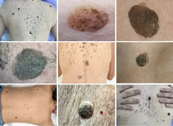 Diverses lésions cutanées, dont des kératoses séborrhéiques. Recherche d'un traitement naturel pour ces affections.