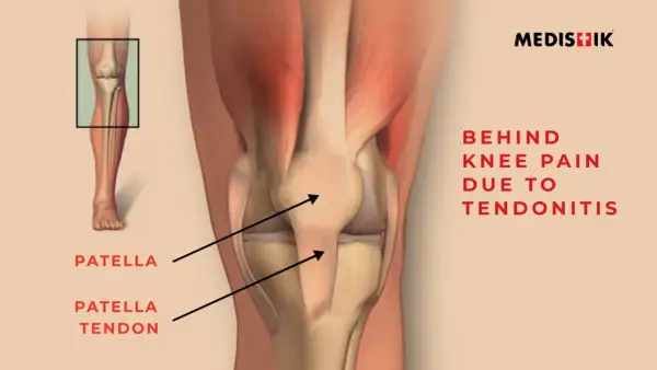 Anatomie du genou montrant le tendon derrière le genou, expliquant la douleur due à la tendinite.