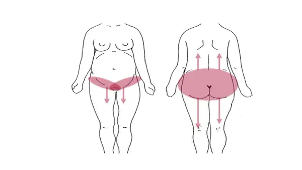 Schéma montrant les zones de douleur pelvienne chez la femme, avec des flèches indiquant la direction de la douleur.
