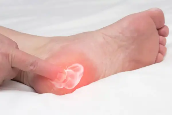 Application de crème sur un pied souffrant d'aponévrosite plantaire. L'alimentation joue un rôle clé dans la guérison.